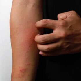 Mengapa Bisa Terjadi Luka Bakar?